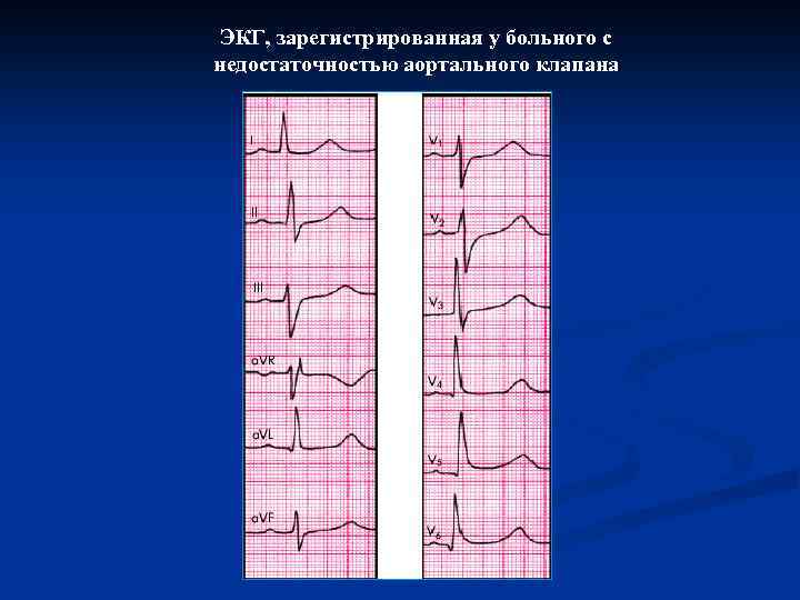ЭКГ, зарегистрированная у больного с недостаточностью аортального клапана 