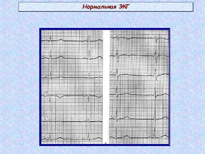 Схема нормальной экг