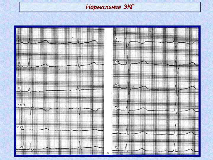 Схема нормальной экг