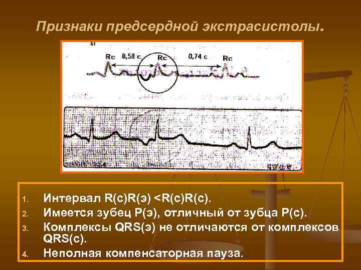 Признаки предсердной экстрасистолы. 1. 2. 3. 4. Интервал R(с)R(э) <R(с). Имеется зубец Р(э), отличный