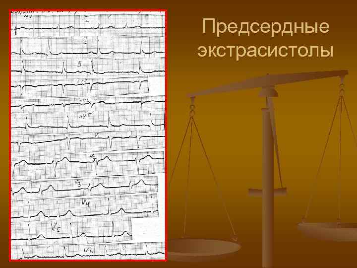 Предсердные экстрасистолы 