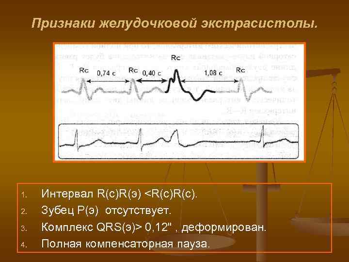 Признаки желудочковой экстрасистолы. 1. 2. 3. 4. Интервал R(с)R(э) <R(с). Зубец Р(э) отсутствует. Комплекс