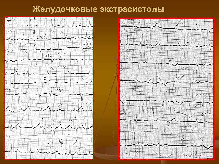Желудочковые экстрасистолы 