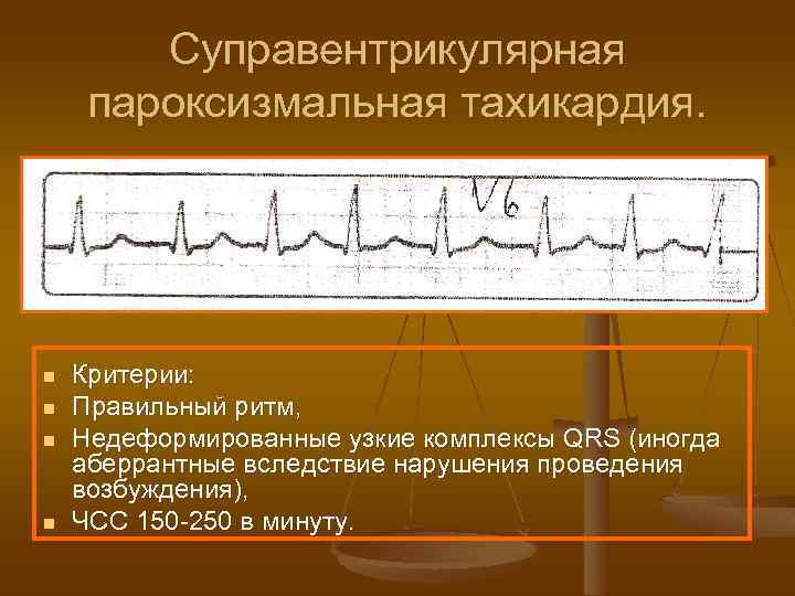 Суправентрикулярная пароксизмальная тахикардия. n n Критерии: Правильный ритм, Недеформированные узкие комплексы QRS (иногда аберрантные