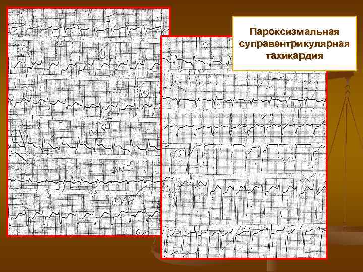 Пароксизмальная суправентрикулярная тахикардия 