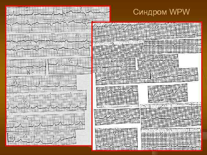 Синдром WPW 