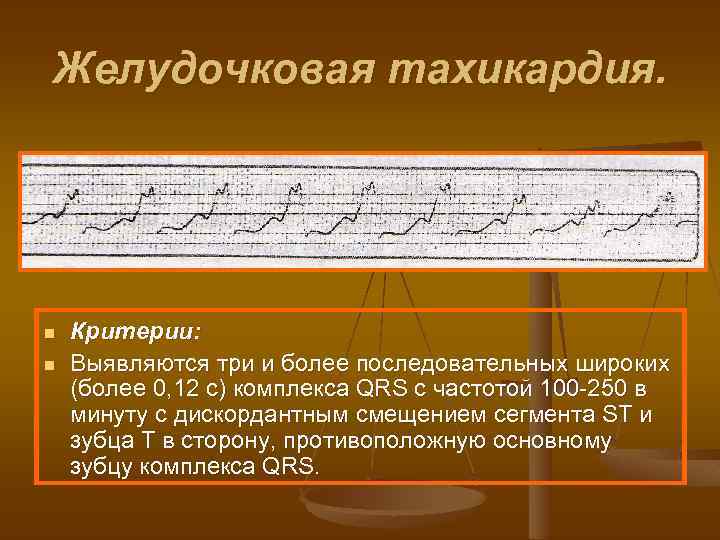 Желудочковая тахикардия. n n Критерии: Выявляются три и более последовательных широких (более 0, 12
