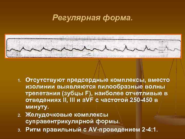 Регулярная форма. 1. 2. 3. Отсутствуют предсердные комплексы, вместо изолинии выявляются пилообразные волны трепетания