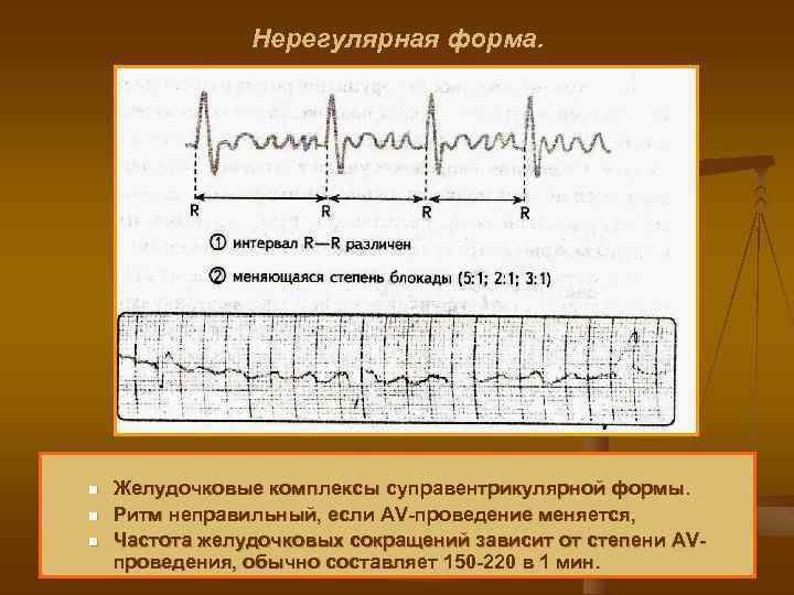 Нерегулярная форма. n n n Желудочковые комплексы суправентрикулярной формы. Ритм неправильный, если AV проведение