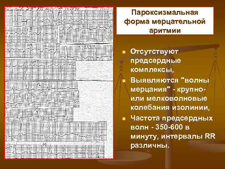 Пароксизмальная форма мерцательной аритмии n n n Отсутствуют предсердные комплексы, Выявляются 