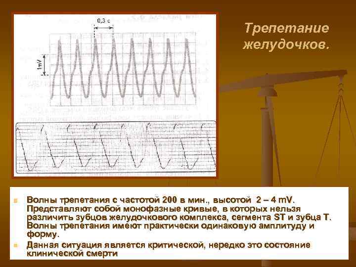 Трепетание желудочков. n n Волны трепетания с частотой 200 в мин. , высотой 2