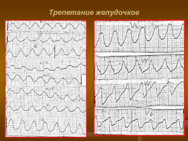 Трепетание желудочков 