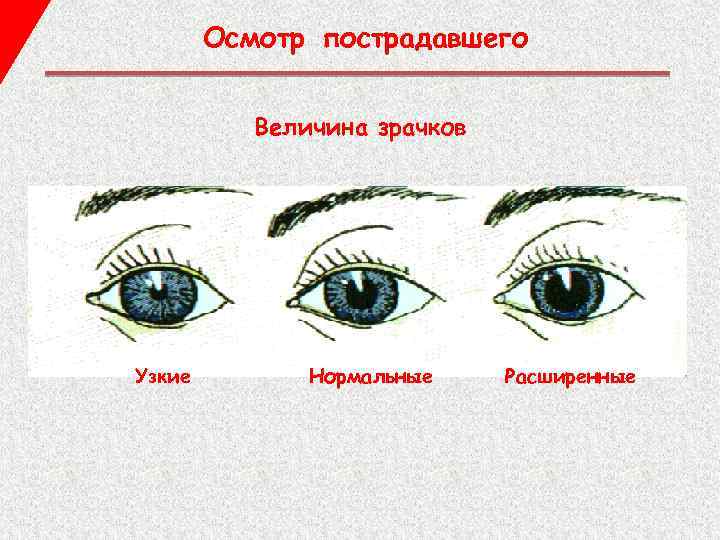 Осмотр пострадавшего Величина зрачков Узкие Нормальные Расширенные 
