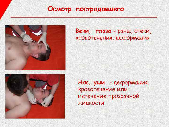 Осмотр пострадавшего Веки, глаза - раны, отеки, кровотечения, деформация Нос, уши - деформация, кровотечение