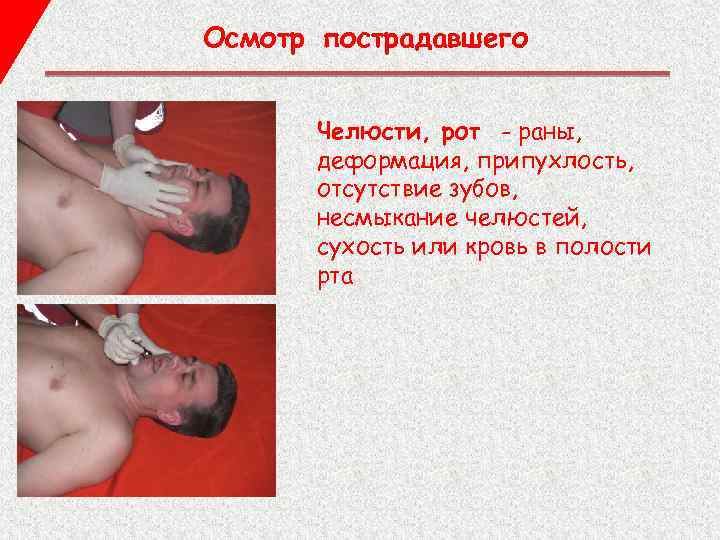 Осмотр пострадавшего Челюсти, рот - раны, деформация, припухлость, отсутствие зубов, несмыкание челюстей, сухость или