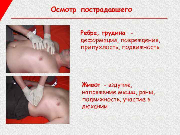 Осмотр пострадавшего Ребра, грудина деформация, повреждения, припухлость, подвижность Живот - вздутие, напряжение мышц, раны,
