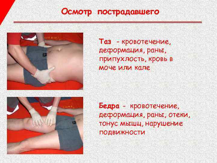 Осмотр пострадавшего Таз - кровотечение, деформация, раны, припухлость, кровь в моче или кале Бедра