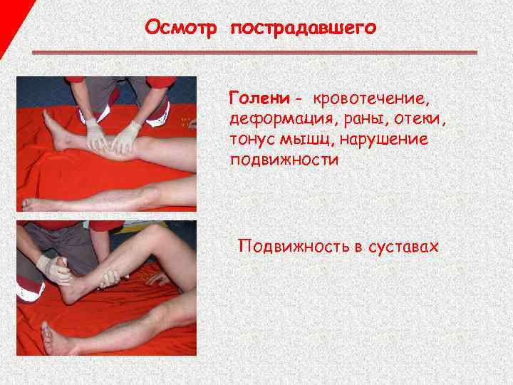 Осмотр пострадавшего Голени - кровотечение, деформация, раны, отеки, тонус мышц, нарушение подвижности Подвижность в
