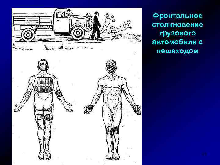 Фронтальное столкновение грузового автомобиля с пешеходом 41 