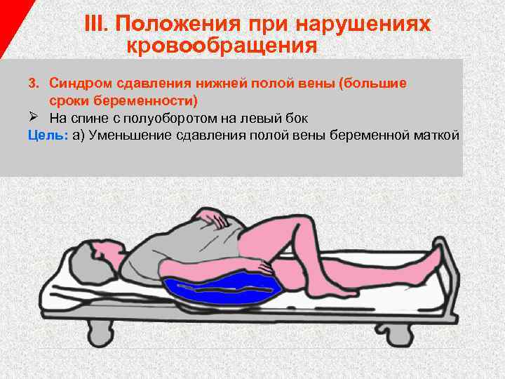 III. Положения при нарушениях кровообращения 3. Синдром сдавления нижней полой вены (большие сроки беременности)