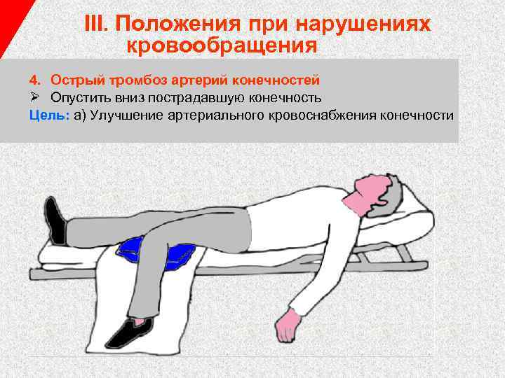 III. Положения при нарушениях кровообращения 4. Острый тромбоз артерий конечностей Ø Опустить вниз пострадавшую