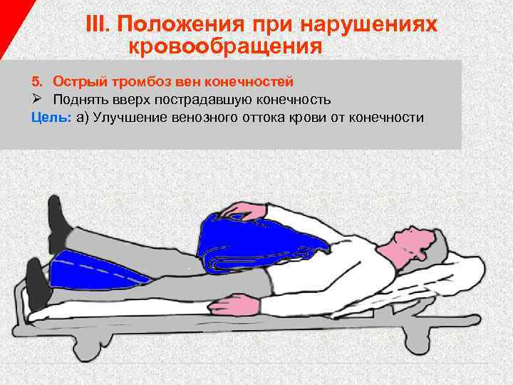 III. Положения при нарушениях кровообращения 5. Острый тромбоз вен конечностей Ø Поднять вверх пострадавшую