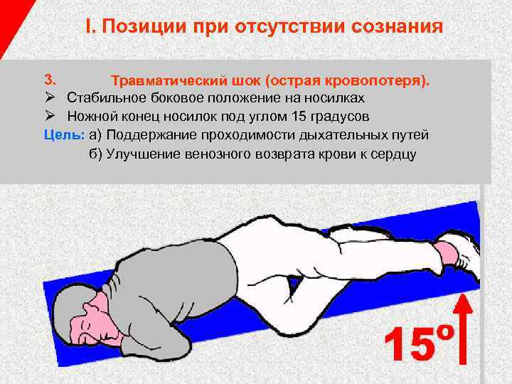 I. Позиции при отсутствии сознания 3. Травматический шок (острая кровопотеря). Ø Стабильное боковое положение