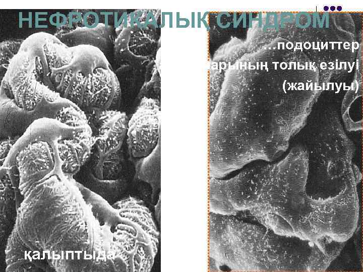 НЕФРОТИКАЛЫҚ СИНДРОМ …подоциттер аяқшаларының толық езілуі (жайылуы) қалыптыда 