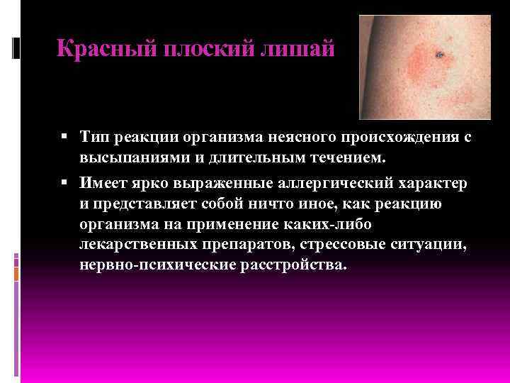 Красный плоский лишай Тип реакции организма неясного происхождения с высыпаниями и длительным течением. Имеет