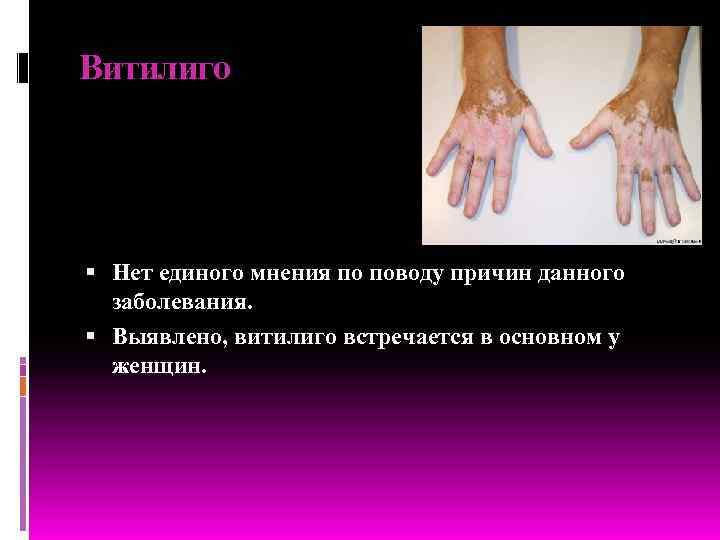 Витилиго Нет единого мнения по поводу причин данного заболевания. Выявлено, витилиго встречается в основном
