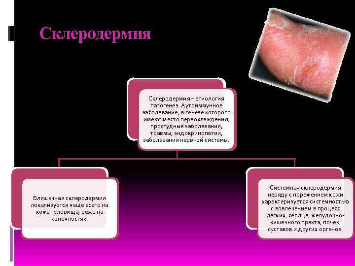 Склеродермия – этиология патогенез. Аутоиммунное заболевание, в генезе которого имеют место переохлаждения, простудные заболевания,