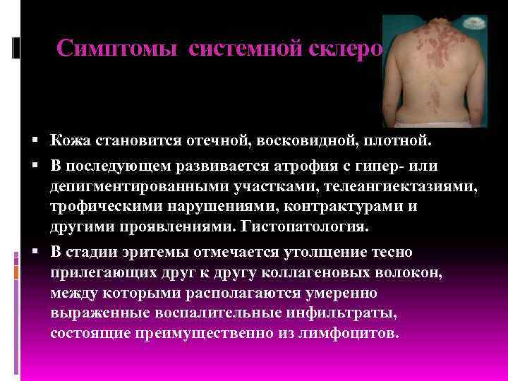 Симптомы системной склеродермии Кожа становится отечной, восковидной, плотной. В последующем развивается атрофия с гипер-