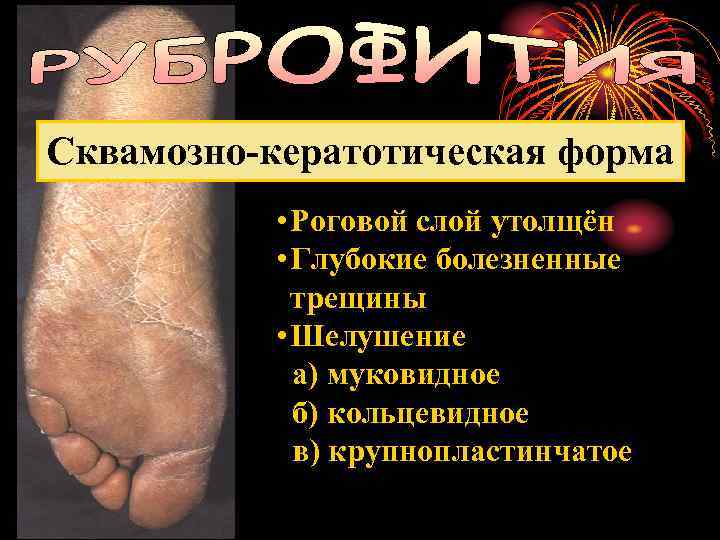 Сквамозно-кератотическая форма • Роговой слой утолщён • Глубокие болезненные трещины • Шелушение а) муковидное