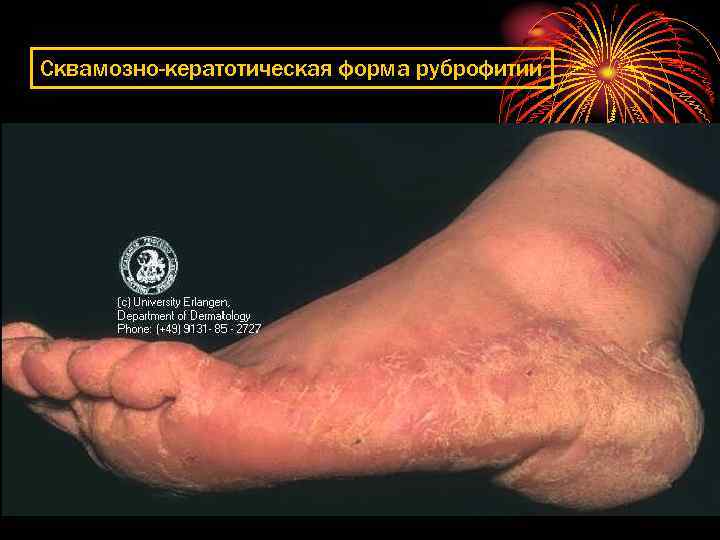 Сквамозно-кератотическая форма руброфитии 