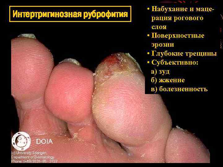Интертригинозная руброфития • Набухание и мацерация рогового слоя • Поверхностные эрозии • Глубокие трещины