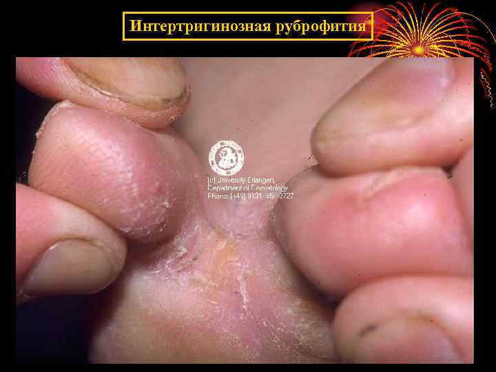 Интертригинозная руброфития 