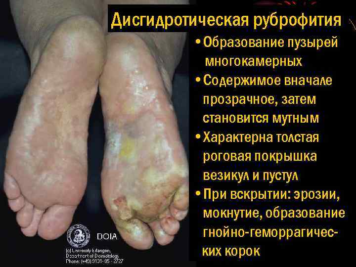 Дисгидротическая руброфития • Образование пузырей многокамерных • Содержимое вначале прозрачное, затем становится мутным •