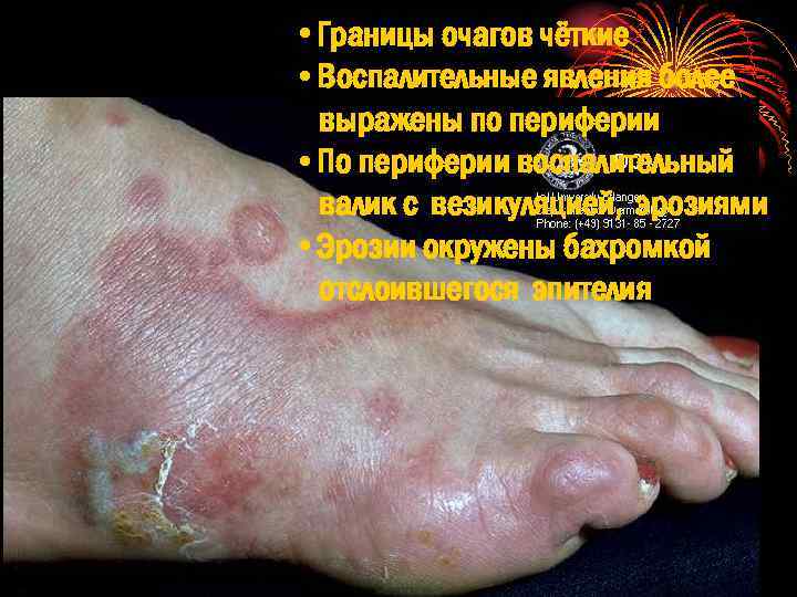  • Границы очагов чёткие • Воспалительные явления более выражены по периферии • По