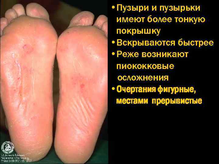  • Пузыри и пузырьки имеют более тонкую покрышку • Вскрываются быстрее • Реже