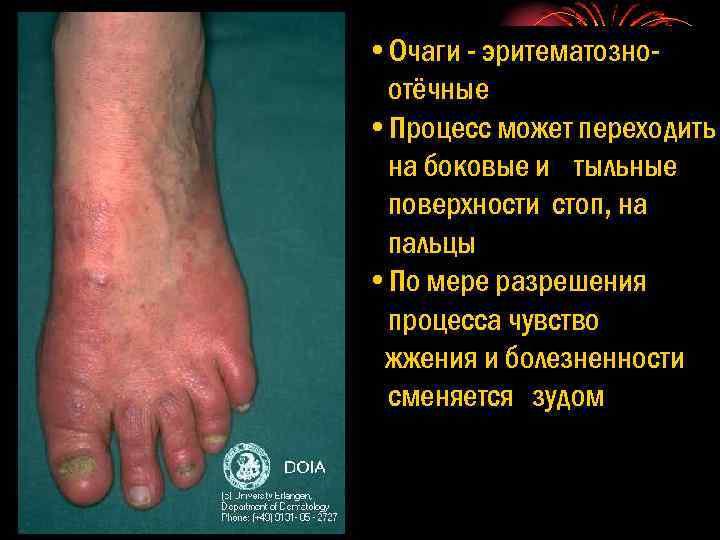  • Очаги - эритематозноотёчные • Процесс может переходить на боковые и тыльные поверхности