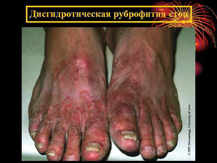 Дисгидротическая руброфития стоп 