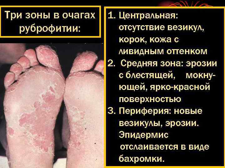 Три зоны в очагах руброфитии: 1. Центральная: отсутствие везикул, корок, кожа с ливидным оттенком