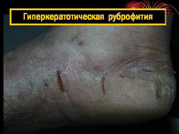 Гиперкератотическая руброфития 