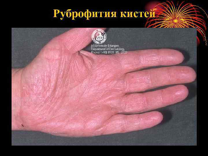 Руброфития кистей 