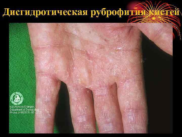 Дисгидротическая руброфития кистей 