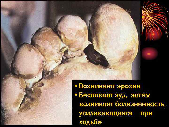  • Возникают эрозии • Беспокоит зуд, затем возникает болезненность, усиливающаяся при ходьбе 