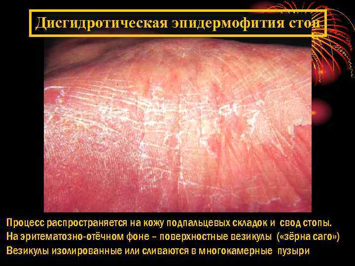 Дисгидротическая эпидермофития стоп Процесс распространяется на кожу подпальцевых складок и свод стопы. На эритематозно-отёчном