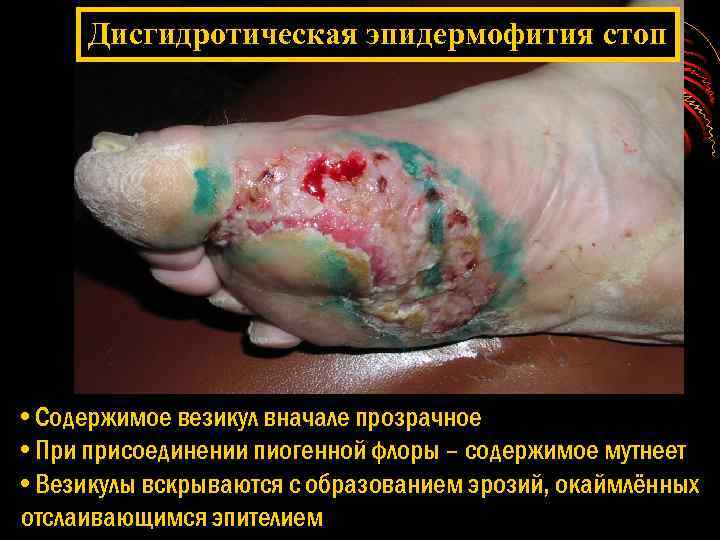 Дисгидротическая эпидермофития стоп • Содержимое везикул вначале прозрачное • При присоединении пиогенной флоры –