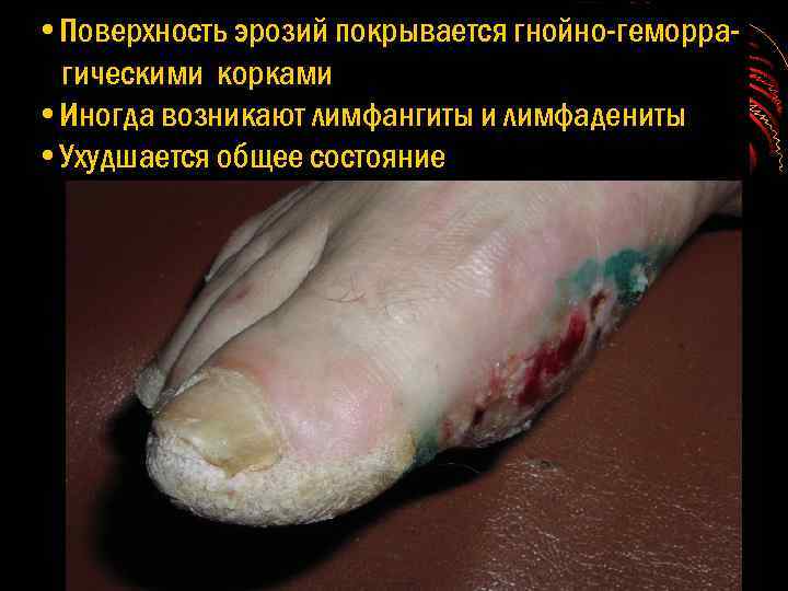  • Поверхность эрозий покрывается гнойно-геморрагическими корками • Иногда возникают лимфангиты и лимфадениты •