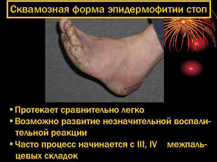 Сквамозная форма эпидермофитии стоп • Протекает сравнительно легко • Возможно развитие незначительной воспалительной реакции